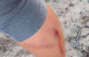 Відому нововолинську фітнес-тренерку покусала вівчарка Відому нововолинську фітнес-тренерку покусала вівчарка