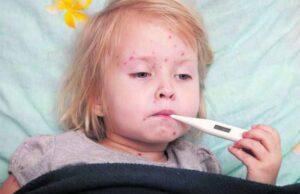 У Нововолинську 16 людей захворіли на кір! У Нововолинську 16 людей захворіли на кір!