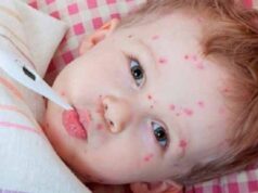 У Нововолинську 30 дітей і 13 дорослих захворіли на кір У Нововолинську 30 дітей і 13 дорослих захворіли на кір