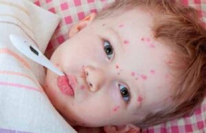 У Нововолинську 30 дітей і 13 дорослих захворіли на кір У Нововолинську 30 дітей і 13 дорослих захворіли на кір