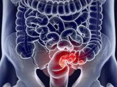 Рак прямої кишки: симптоми та причини Рак прямої кишки, або колоректальний рак — це злоякісне новоутворення кінцевого відділу кишківника. Захворювання є доволі поширеним серед людей старше 40 років. Статистика свідчить, що чоловіки частіше страждають на цю хворобу, ніж жінки. З’ясуємо основні симптоми та причини небезпечного діагнозу.