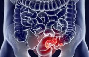 Рак прямої кишки: симптоми та причини Рак прямої кишки, або колоректальний рак — це злоякісне новоутворення кінцевого відділу кишківника. Захворювання є доволі поширеним серед людей старше 40 років. Статистика свідчить, що чоловіки частіше страждають на цю хворобу, ніж жінки. З’ясуємо основні симптоми та причини небезпечного діагнозу.