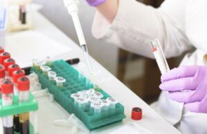 Яка група крові підвищує ризик раннього інсульту — що з’ясували генетики Яка-група-крові-підвищує-ризик-раннього-інсульту —-що з’ясували-генетики