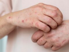 В Україні фіксують зростання захворюваності на вітрянку: яка ситуація на Волині В-Україні-фіксують-зростання-захворюваності-на-вітрянку:-яка-ситуація-на-Волині