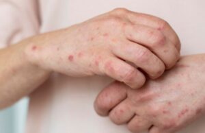 В Україні фіксують зростання захворюваності на вітрянку: яка ситуація на Волині В-Україні-фіксують-зростання-захворюваності-на-вітрянку:-яка-ситуація-на-Волині