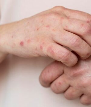 В-Україні-фіксують-зростання-захворюваності-на-вітрянку:-яка-ситуація-на-Волині