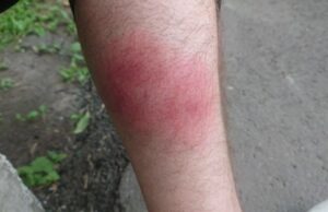 Чому чухати укус комахи шкідливо — буде тільки гірше Чому-чухати-укус-комахи-шкідливо —-буде-тільки-гірше