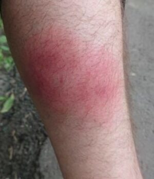 Чому-чухати-укус-комахи-шкідливо —-буде-тільки-гірше