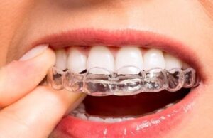 Як та навіщо носити елайнери: дбаємо про прикус Як-та-навіщо-носити-елайнери:-дбаємо-про-прикус