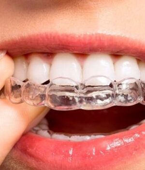 Як-та-навіщо-носити-елайнери:-дбаємо-про-прикус Як-та-навіщо-носити-елайнери:-дбаємо-про-прикус