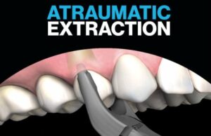 Що таке атравматичне видалення зубів Що-таке-атравматичне-видалення-зубів