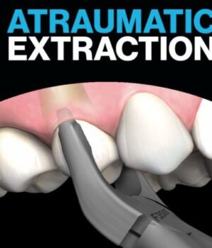 Що-таке-атравматичне-видалення-зубів