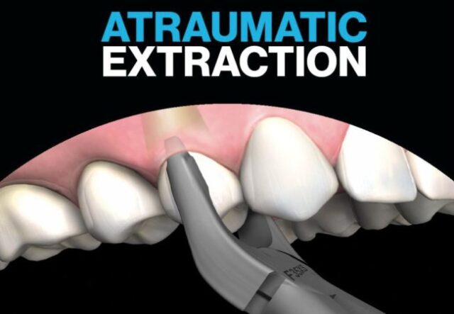 Що таке атравматичне видалення зубів Що-таке-атравматичне-видалення-зубів
