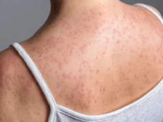 Кір поширюється у школах Лондона, десятки дітей захворіли Кір-поширюється-у-школах-Лондона,-десятки-дітей-захворіли