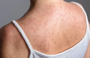 Кір поширюється у школах Лондона, десятки дітей захворіли Кір-поширюється-у-школах-Лондона,-десятки-дітей-захворіли