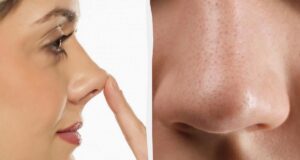 Ваш ніс – дрібниця: у одного чоловіка він був довший за олівець Ваш-ніс-–-дрібниця:-у-одного-чоловіка-він-був-довший-за-олівець