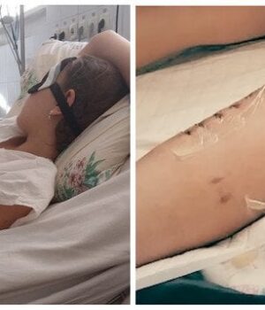 Довелось-ампутувати-ногу:-собака-напав-на дівчинку-на Дніпропетровщині-(фото)