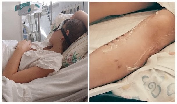 Довелось ампутувати ногу: собака напав на дівчинку на Дніпропетровщині (фото) Довелось-ампутувати-ногу:-собака-напав-на дівчинку-на Дніпропетровщині-(фото)