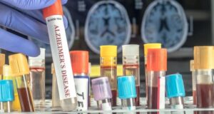 Аналіз крові може передбачити ризик деменції у жінок за десятки років до появи симптомів, –... Аналіз-крові-може-передбачити-ризик-деменції-у-жінок-за-десятки-років-до-появи-симптомів,-–.