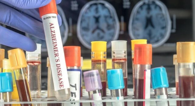 Аналіз крові може передбачити ризик деменції у жінок за десятки років до появи симптомів, –... Аналіз-крові-може-передбачити-ризик-деменції-у-жінок-за-десятки-років-до-появи-симптомів,-–.