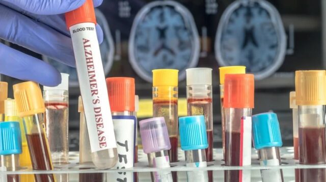 Аналіз крові може передбачити ризик деменції у жінок за десятки років до появи симптомів, –... Аналіз-крові-може-передбачити-ризик-деменції-у-жінок-за-десятки-років-до-появи-симптомів,-–.