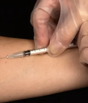 В-Україні-відмовляються-від-проби-Манту-–-як-виявлятимуть-туберкульоз-надалі