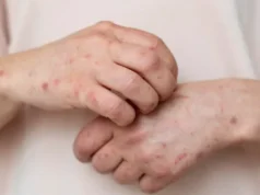 На Прикарпатті ліквідували п’ять спалахів кору На Прикарпатті ліквідували п’ять спалахів кору