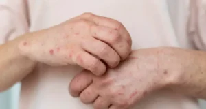 На Прикарпатті ліквідували п’ять спалахів кору На Прикарпатті ліквідували п’ять спалахів кору