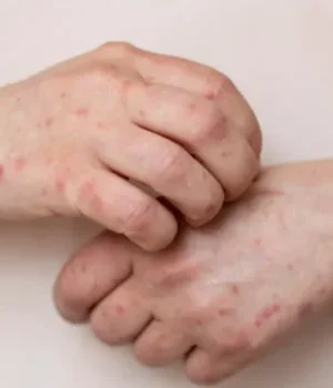 photo_2026_04_15_20_56_51.webp На Прикарпатті ліквідували п’ять спалахів кору