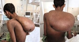 Фермер із гігантською пухлиною на шиї вагою 25 кг впав у депресію та не міг їсти — фото Фермер-із гігантською-пухлиною-на шиї-вагою-25 кг впав-у депресію-та не міг-їсти —-фото