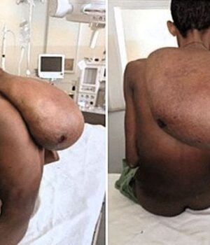 Фермер-із гігантською-пухлиною-на шиї-вагою-25 кг впав-у депресію-та не міг-їсти —-фото