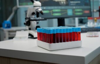 Як підготуватися до біохімії крові, щоб результати були максимально точними Як-підготуватися-до-біохімії-крові,-щоб-результати-були-максимально-точними